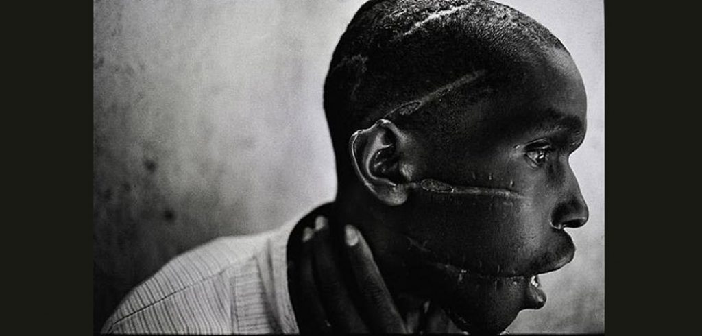 Photo of Injured African Boy